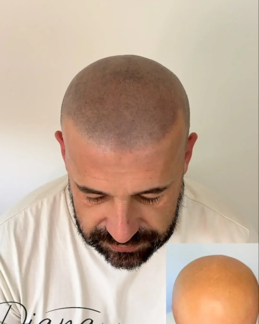 Resultado de micropigmentación capilar efecto rapado